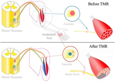 Broadband Prosthetic Interfaces: Combining Nerve Transfers and Implantable Multichannel EMG Technology to Decode <mark class="highlighted">Spinal Motor Neuron</mark> Activity